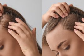 woman hair growth